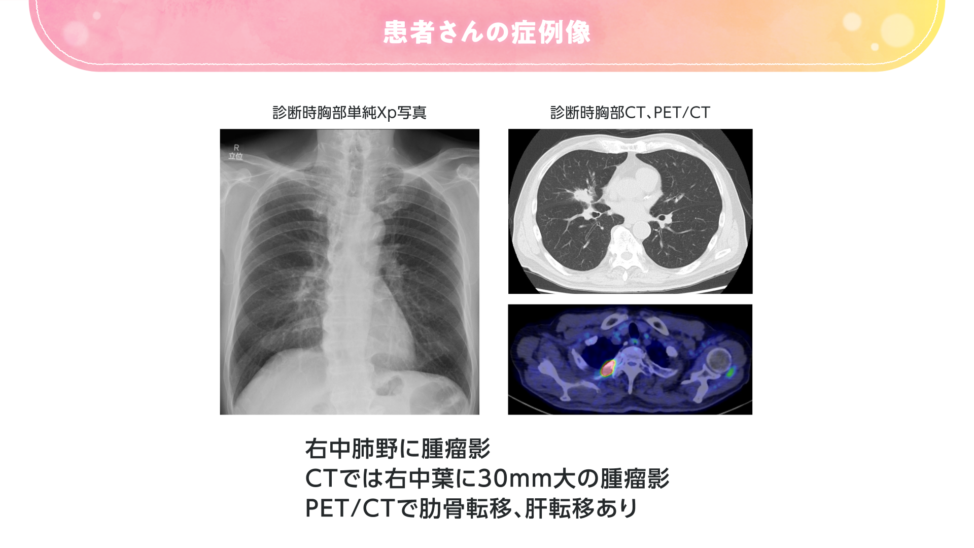 アルンブリグ錠 30mg・90mg｜【公式】武田薬品 医療関係者向け情報