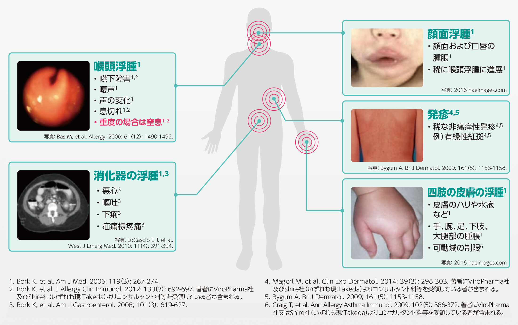TKZ_見落とされやすいHAE患者さんの疾病負荷
