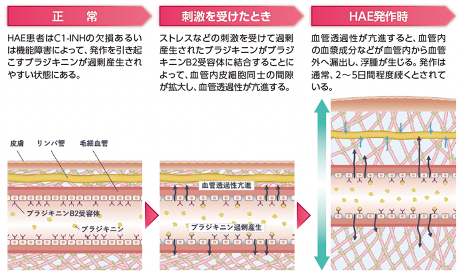 TKZ_HAE発作によるブラジキニン産生