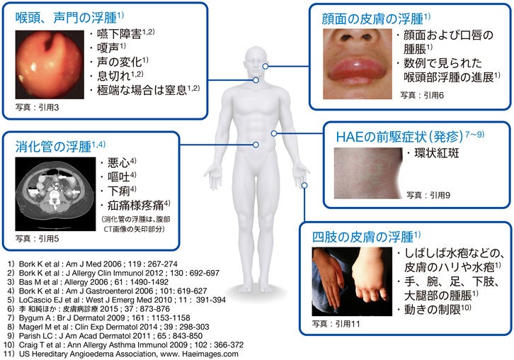 図1 発作部位別のHAEの症状