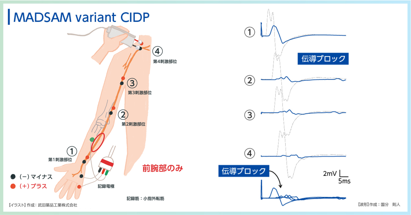 Multifocal CIDP(MADSAM)