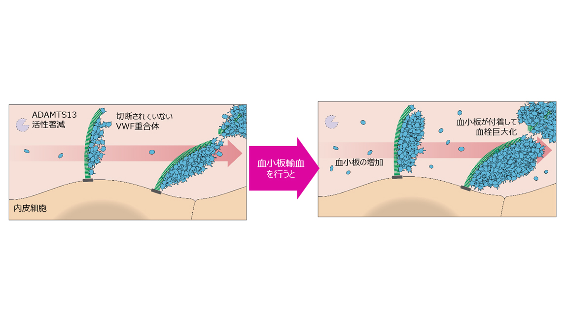 図6:TTPへの血小板輸血