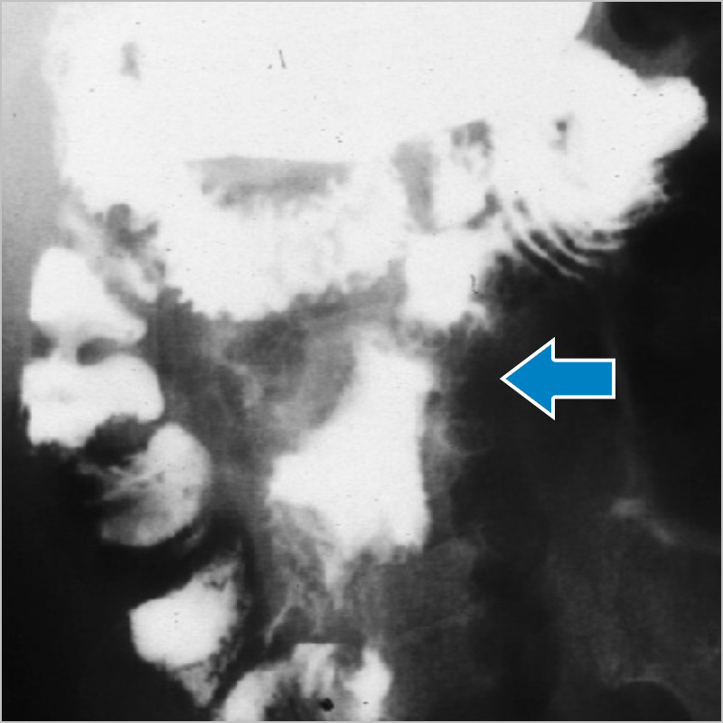 図1 残存小腸（矢印）25cmの短腸症候群の消化管造影